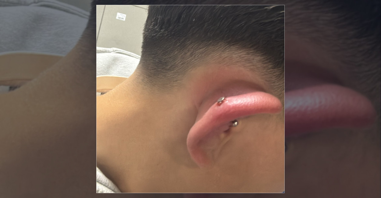 Bursa’da piercing yaptıran genç hastanelik oldu