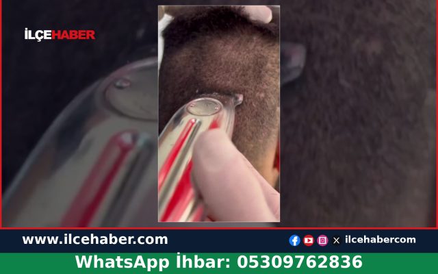 Berberden Tuz, Karbonat ve Limonla Saç Derisi Bakımı